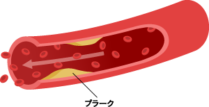動脈硬化症の進行2