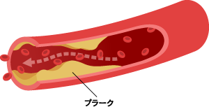 動脈硬化症の進行3
